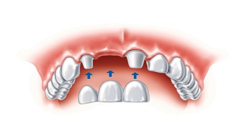 5 Options For Replacing Your Missing Teeth